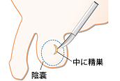 Conventional TESE（testicular sperm extraction／精巣精子採取術）イメージ