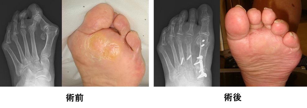 重症外反母趾に対する変形矯正手術 | 獨協医科大学埼玉医療センター 整形外科