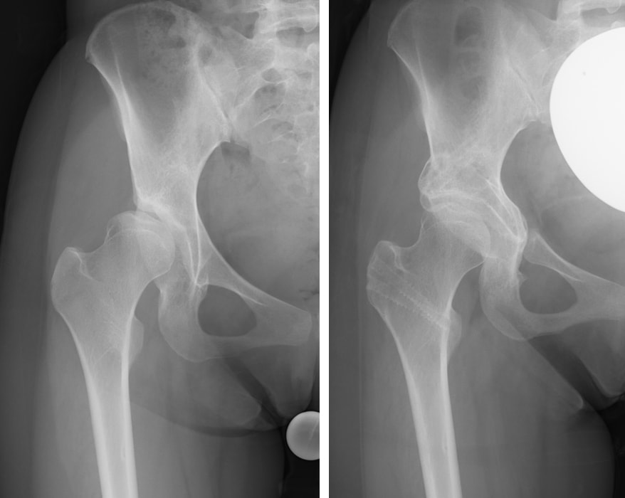 股関節周囲骨切り術 | 獨協医科大学埼玉医療センター 整形外科