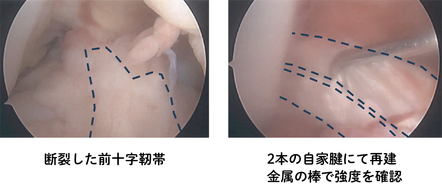 前十字靭帯再建手術 | 獨協医科大学埼玉医療センター 整形外科