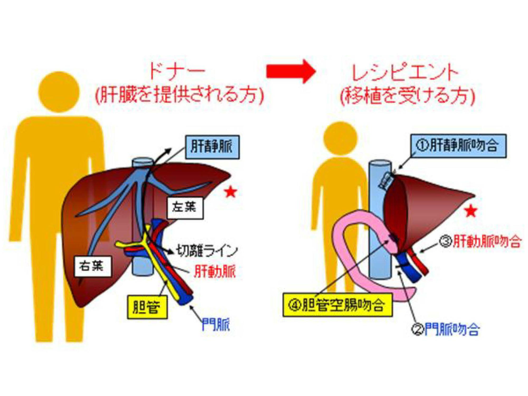 肝臓の寄付の費用はいくらですか?