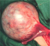 胚 細胞 腫瘍