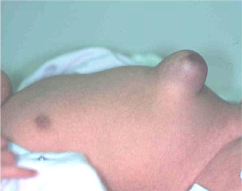 ヘルニア 赤ちゃん 臍 臍ヘルニア：症状、原因、診断