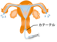 卵管通水検査イメージ