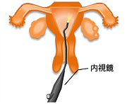 子宮鏡検査イメージ