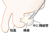 MD-TESE（microdissection TESE／顕微鏡下精巣精子採取術）イメージ