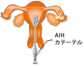 人工授精イメージ