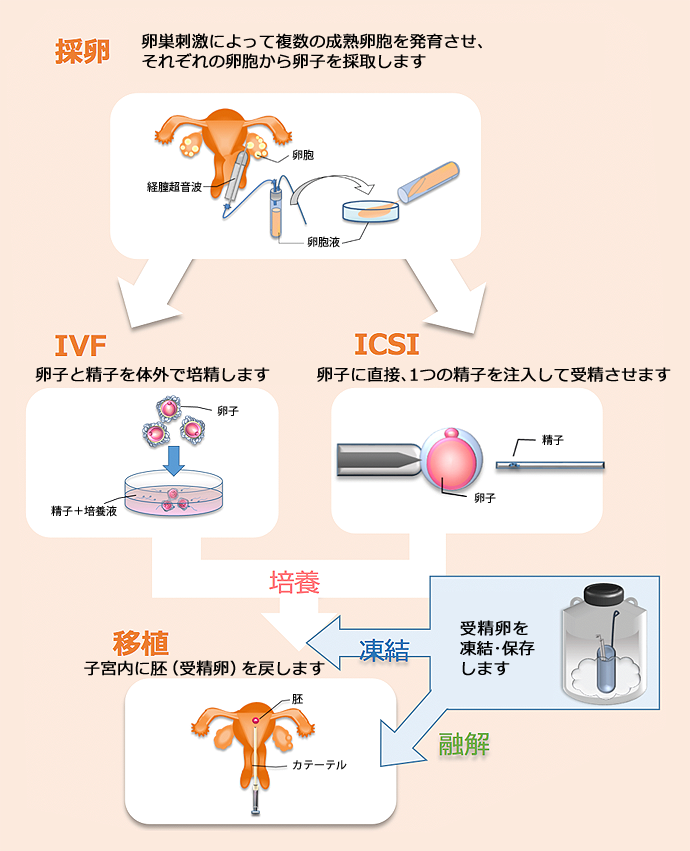 体外受精・顕微授精の流れ図
