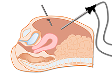 腹腔鏡検査・腹腔鏡下手術イメージ
