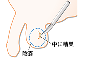 Conventional TESE(testicular sperm extraction/精巣精子採取術)イメージ