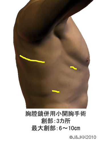 胸腔鏡併用小開胸手術