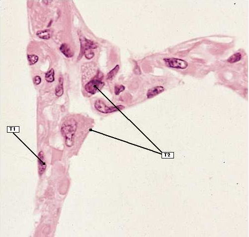 type-2-pneumocyte-and-surfactant